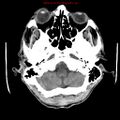 Cerebral and orbital tuberculomas (Radiopaedia 13308-13310 Axial non-contrast 5).jpg