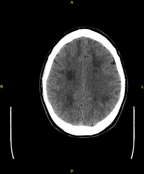 File:Cerebral autosomal dominant arteriopathy with subcortical infarcts and leukoencephalopathy (CADASIL) (Radiopaedia 86108-102051 Axial non-contrast 75).jpg