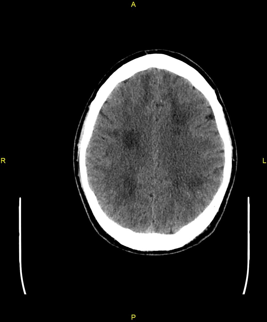 Cerebral autosomal dominant arteriopathy with subcortical infarcts and leukoencephalopathy (CADASIL) (Radiopaedia 86108-102051 Axial non-contrast 75).jpg