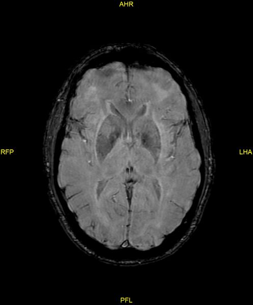 File:Cerebral autosomal dominant arteriopathy with subcortical infarcts and leukoencephalopathy (CADASIL) (Radiopaedia 86108-102054 Axial SWI 57).jpg