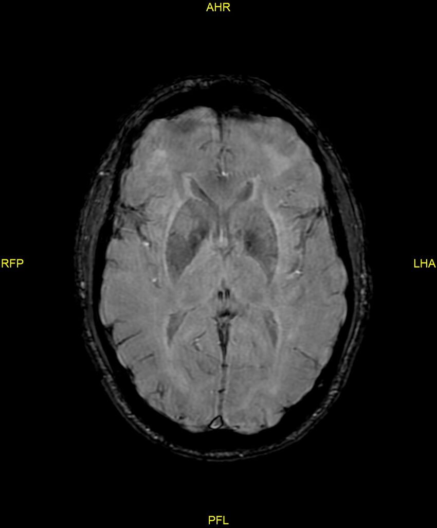 Cerebral autosomal dominant arteriopathy with subcortical infarcts and leukoencephalopathy (CADASIL) (Radiopaedia 86108-102054 Axial SWI 57).jpg