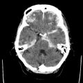 Cerebral hemorrhagic contusions (Radiopaedia 23145-23188 Axial non-contrast 11).jpg