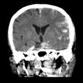 Cerebral hemorrhagic contusions (Radiopaedia 23145-23188 Coronal non-contrast 21).jpg