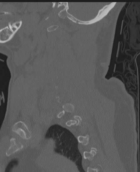 File:Cerebral hemorrhagic contusions and cervical spine fractures (Radiopaedia 32865-33841 Sagittal bone window 29).jpg