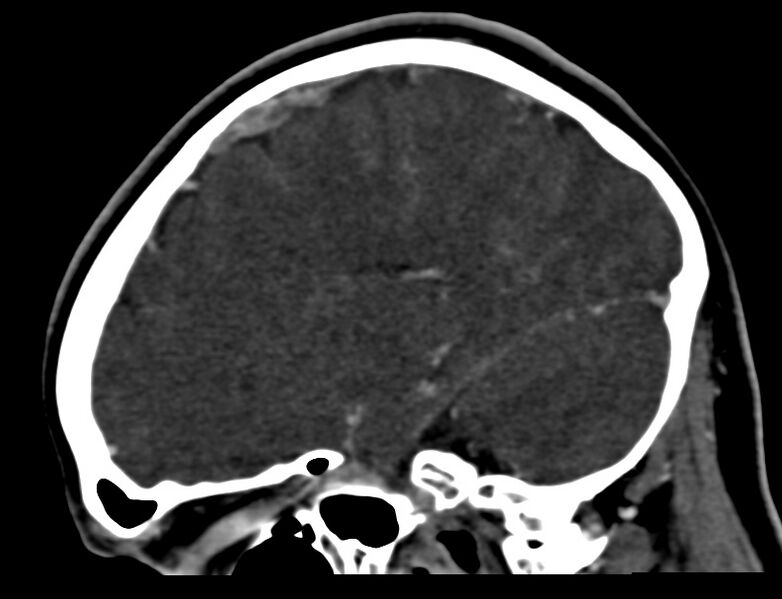 File:Cerebral venous sinus thrombosis (Radiopaedia 59224-66646 Sagittal C+ delayed 13).jpg