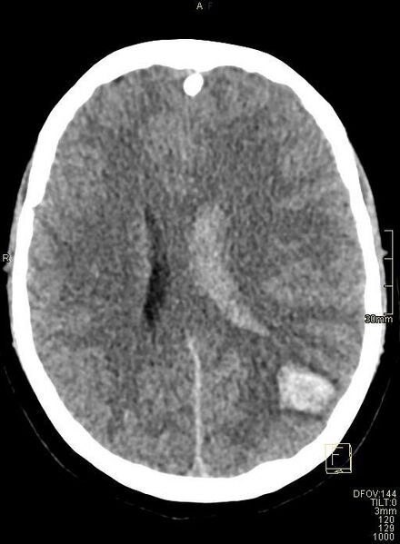 File:Cerebral venous sinus thrombosis (Radiopaedia 91329-108965 Axial non-contrast 31).jpg