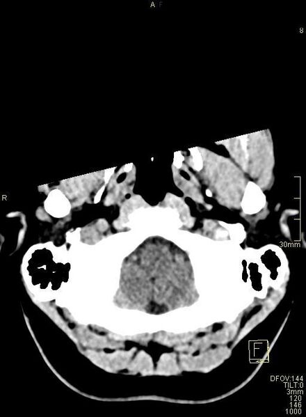 File:Cerebral venous sinus thrombosis (Radiopaedia 91329-108965 Axial non-contrast 6).jpg
