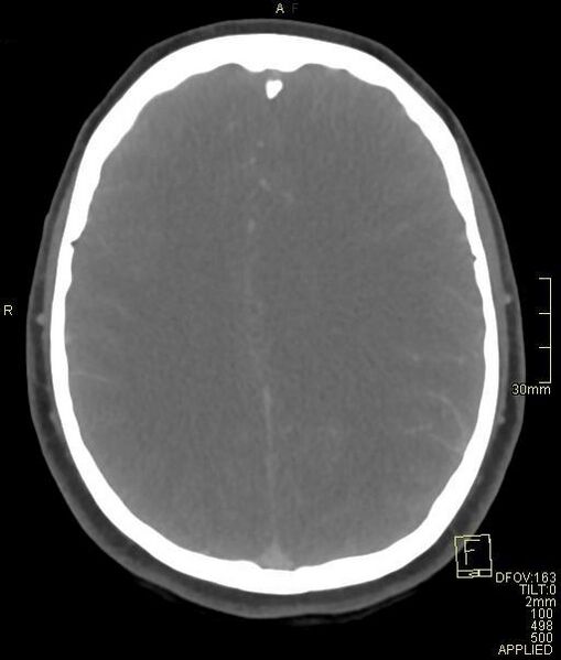 File:Cerebral venous sinus thrombosis (Radiopaedia 91329-108965 Axial venogram 53).jpg