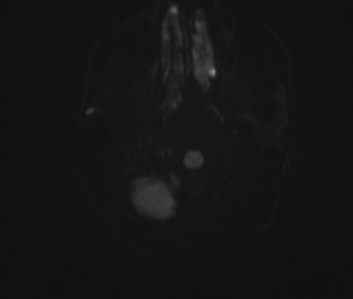 File:Cerebral venous thrombosis (Radiopaedia 71207-81504 Axial DWI 1).jpg