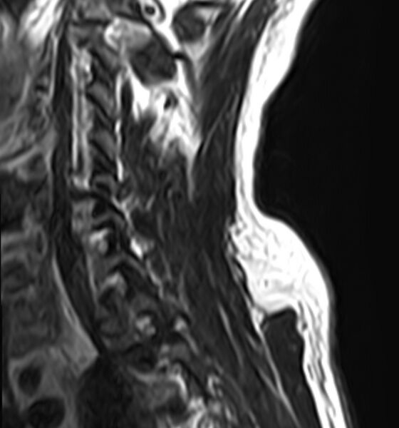 File:Cervical compressive myelopathy (Radiopaedia 71956-82411 C 4).jpg
