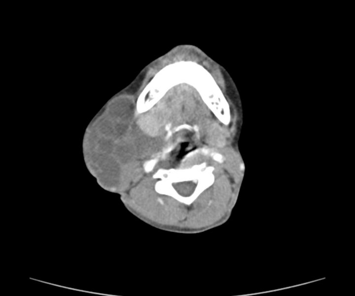 File:Cervical cystic lymphangioma (Radiopaedia 63655-72332 Axial + contrast 15).jpg
