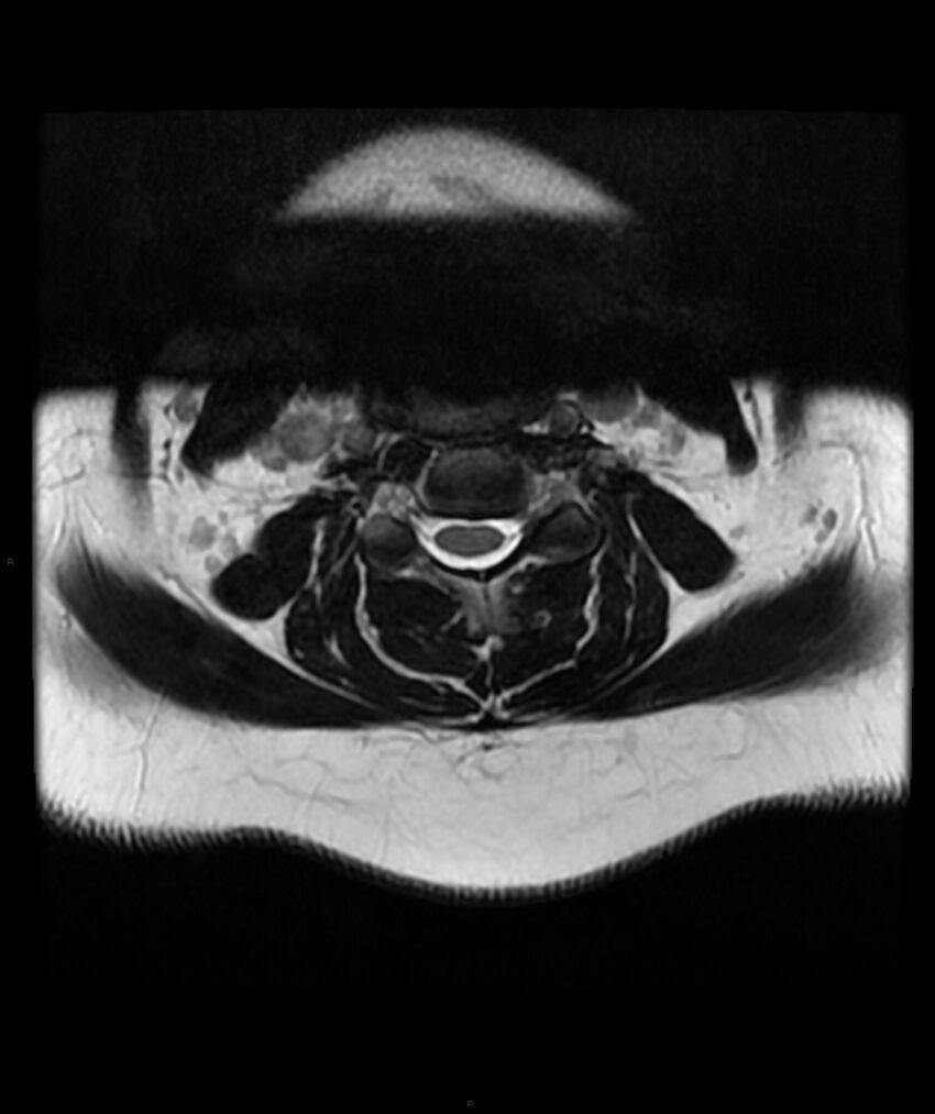 Cervical disc prolapse (Radiopaedia 80258-93598 Axial T2 24).jpg