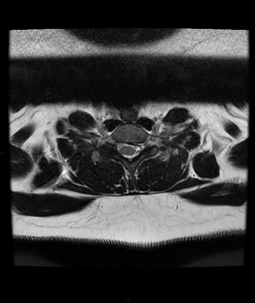 File:Cervical disc prolapse (Radiopaedia 80258-93598 Axial T2 67).jpg