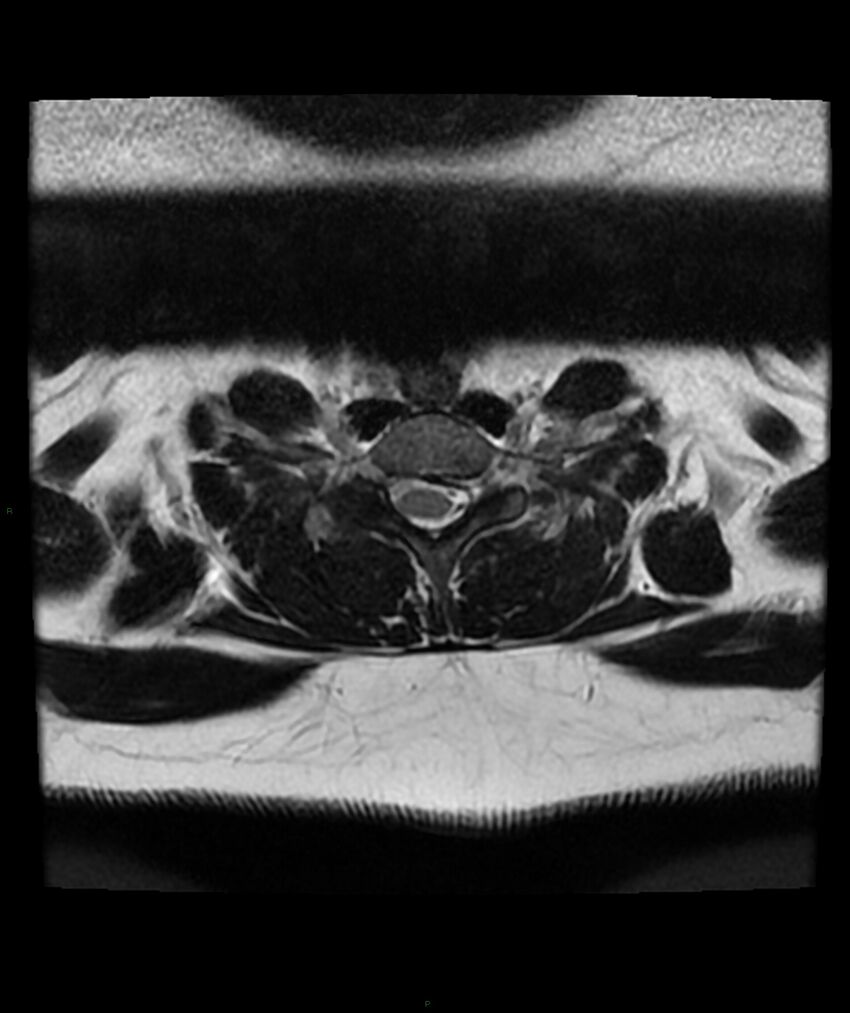 Cervical disc prolapse (Radiopaedia 80258-93598 Axial T2 67).jpg