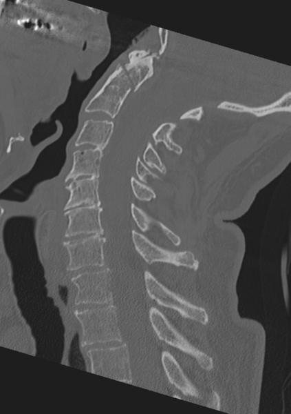 File:Cervical spine fractures with vertebral artery dissection (Radiopaedia 53296-59268 Sagittal bone window 35).png