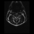 Cervical vertebrae metastasis (Radiopaedia 78814-91667 Axial T2 15).png