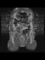 Cesarean section scar endometrioma (Radiopaedia 56569-63297 Coronal STIR 7).jpg