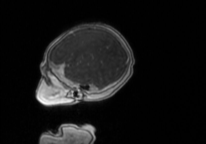 Chiari III malformation with occipital encephalocele (Radiopaedia 79446-92559 Sagittal T1 C+ mpr 55).jpg