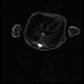 Chiari II malformation with spinal meningomyelocele (Radiopaedia 23550-23652 Axial T2 5).jpg