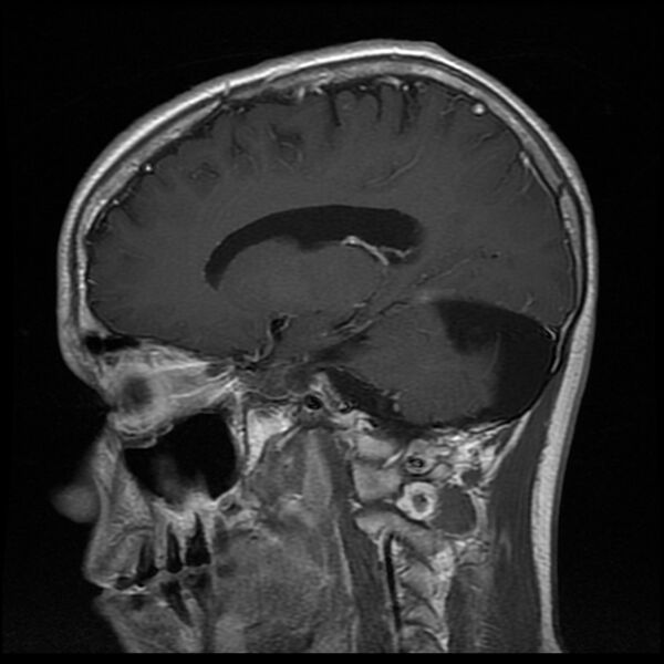 File:Chiasmatic-hypothalamic juvenile pilocytic astrocytoma (Radiopaedia 78533-91236 Sagittal T1 C+ 10).jpg