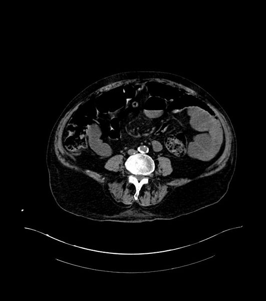 File:Cholangiocarcinoma with cerebral metastases (Radiopaedia 83519-98629 Axial non-contrast 73).jpg