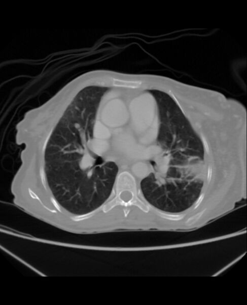 File:Chondrosarcoma (Radiopaedia 79427-92535 Axial lung window 26).jpg