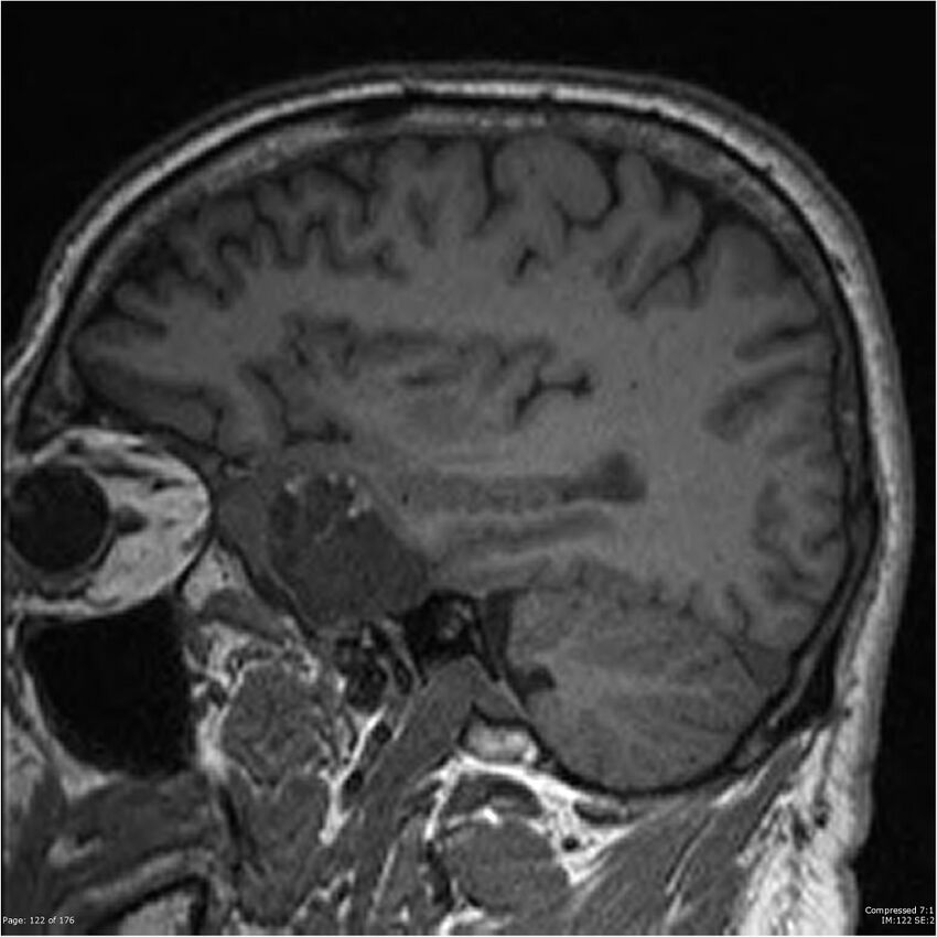 Chondrosarcoma of skull base- grade II (Radiopaedia 40948-43654 Sagittal T1 45).jpg