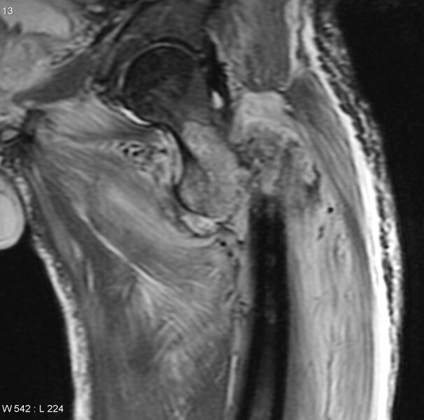 File:Chondrosarcoma with pathological fracture - femur (Radiopaedia 6174-7629 Coronal STIR 4).jpg