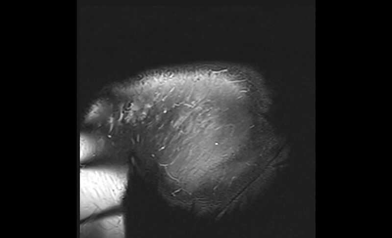 File:Choriocarcinoma in the shoulder (Radiopaedia 28603-28861 Coronal PD FS 33).jpg