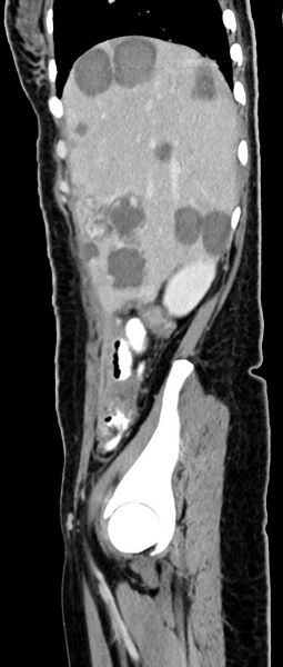 File:Choriocarcinoma liver metastases (Radiopaedia 74768-85766 C 135).jpg