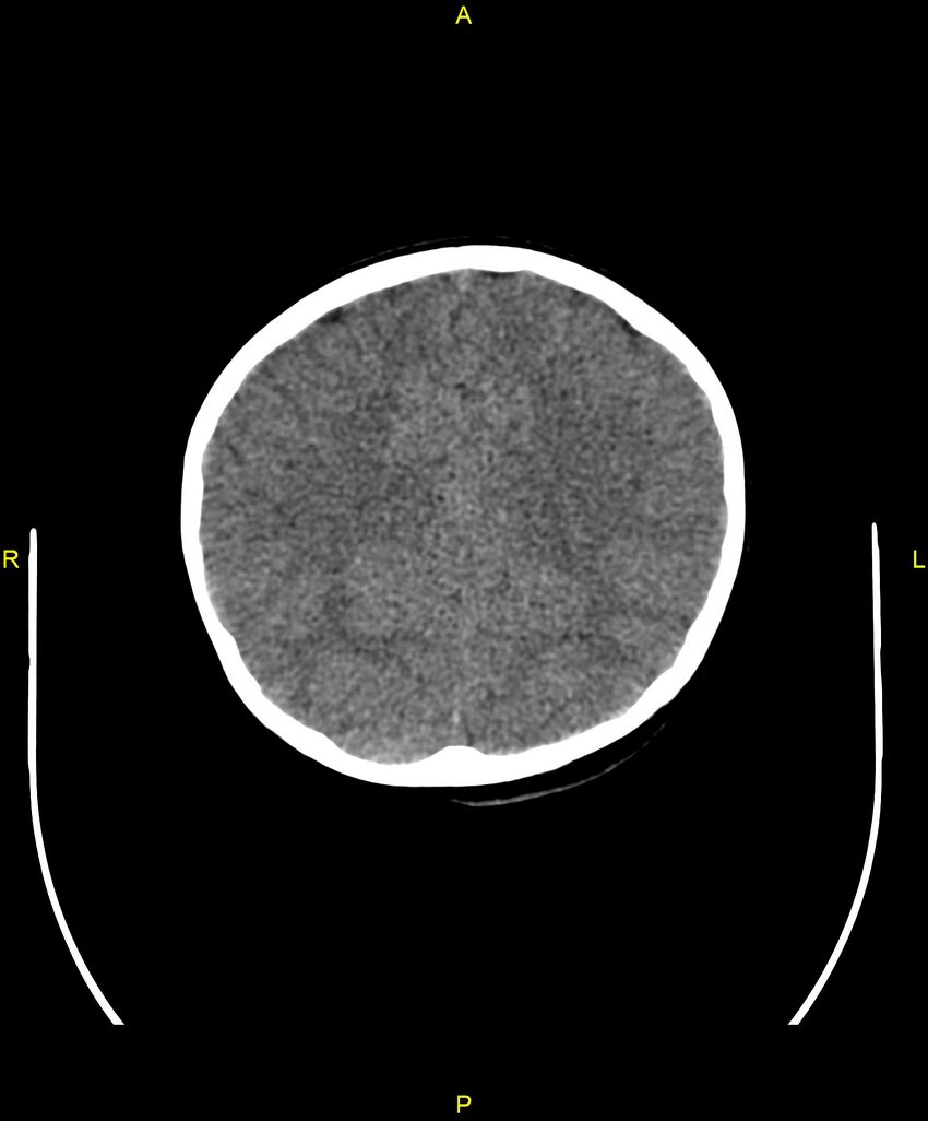Choroidal fissure cyst (Radiopaedia 89481-106465 Axial non-contrast 84).jpg