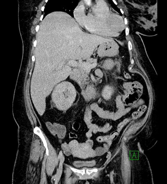 File:Chromophobe renal cell carcinoma (Radiopaedia 84239-99519 F 39).jpg