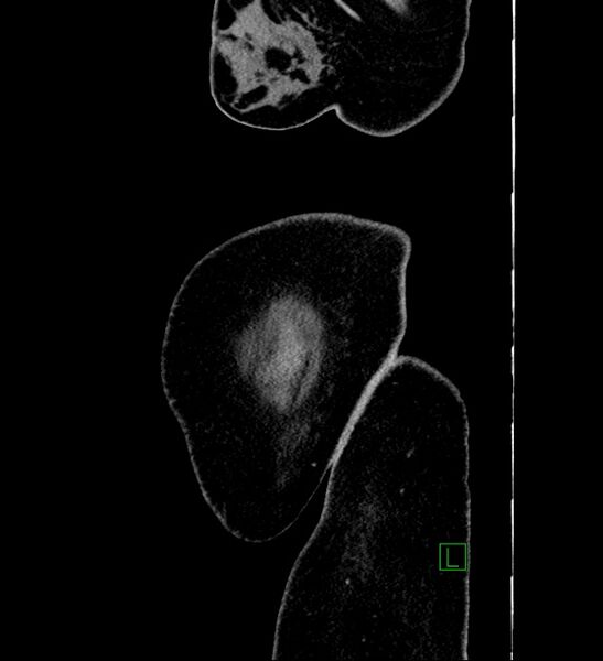 File:Chromophobe renal cell carcinoma (Radiopaedia 84239-99519 G 1).jpg