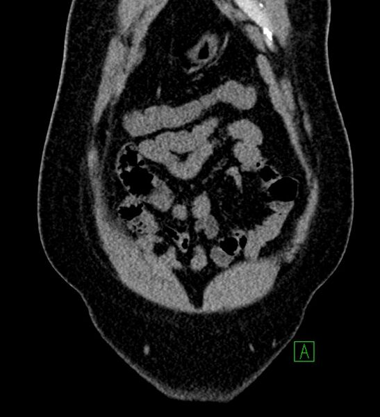 File:Chromophobe renal cell carcinoma (Radiopaedia 84286-99573 Coronal non-contrast 24).jpg