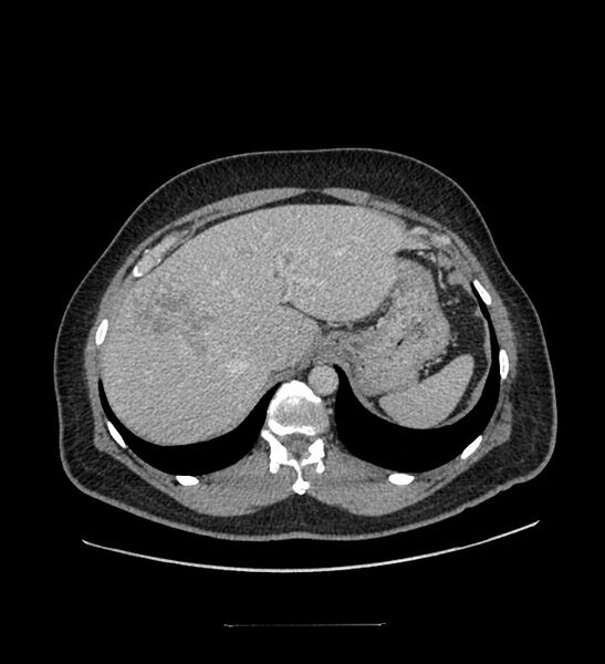 File:Chromophobe renal cell carcinoma (Radiopaedia 84337-99644 C 27).jpg