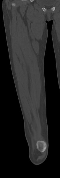 File:Chronic ostemyelitis of the femur with long sinus tract (Radiopaedia 74947-85982 Coronal bone window 27).jpg