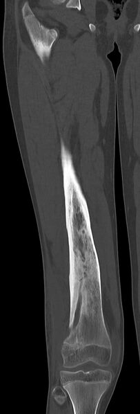 File:Chronic ostemyelitis of the femur with long sinus tract (Radiopaedia 74947-85982 Coronal bone window 44).jpg