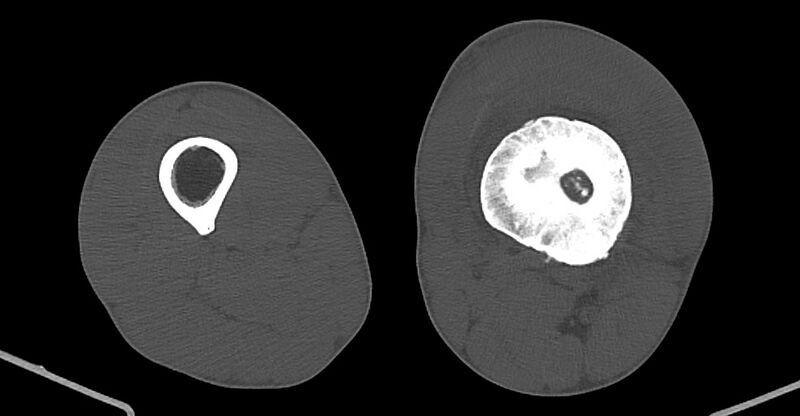 File:Chronic osteomyelitis (with sequestrum) (Radiopaedia 74813-85822 Axial non-contrast 132).jpg
