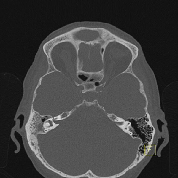 File:Chronic otitis media (Radiopaedia 14994-14912 Axial bone window 4).JPEG