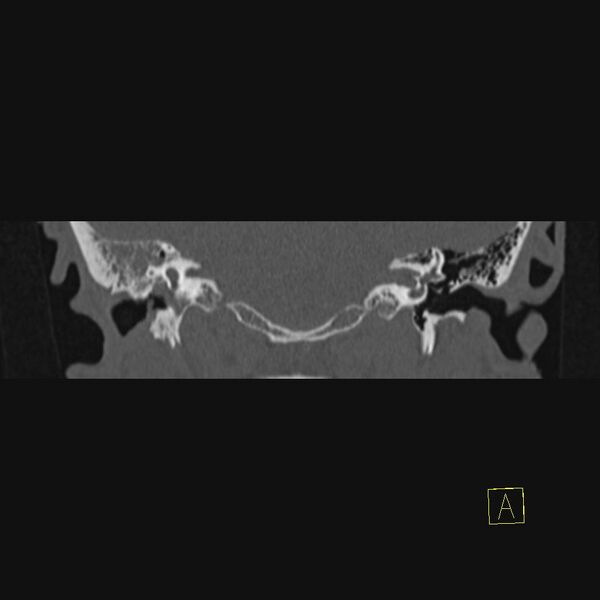 File:Chronic otitis media (Radiopaedia 14994-14912 Coronal bone window 7).JPEG