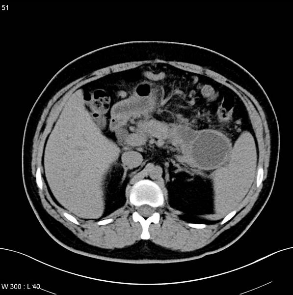 File:Chronic pancreatitis and pseudocysts (Radiopaedia 6724-7935 Axial non-contrast 6).jpg