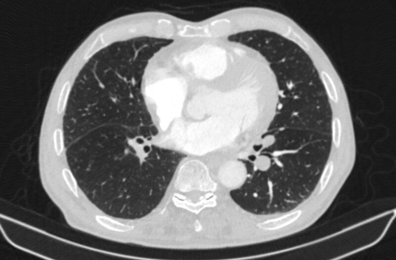 File:Chronic pulmonary embolism (Radiopaedia 91241-108843 Axial lung window 57).jpg