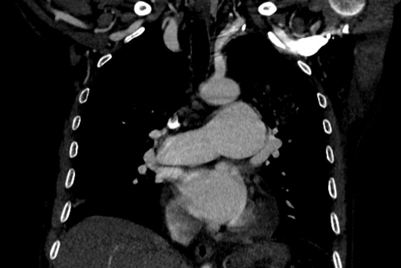 File:Chronic pulmonary embolism with bubbly consolidation (Radiopaedia 91248-108850 B 71).jpg