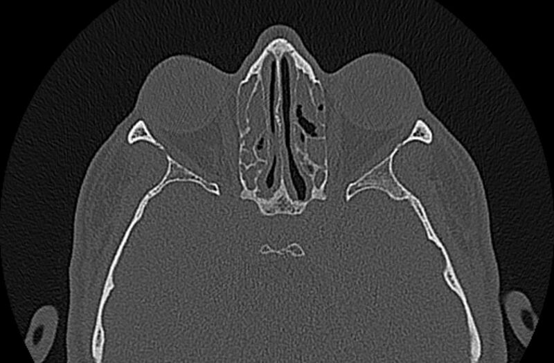 File:Chronic rhinosinusitis (Radiopaedia 65079-74075 Axial bone window 54).jpg