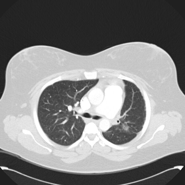 File:Chronic thromboembolic pulmonary hypertension (CTEPH) (Radiopaedia 74597-85531 Axial lung window 20).jpg