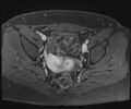 Class II Mullerian duct anomaly- unicornuate uterus with rudimentary horn and non-communicating cavity (Radiopaedia 39441-41755 Axial T1 fat sat 70).jpg
