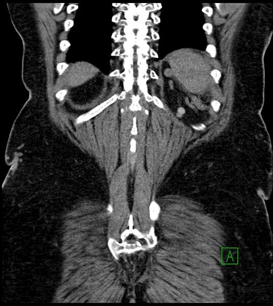 File:Closed-loop small bowel obstruction-internal hernia (Radiopaedia 78439-91096 Coronal non-contrast 86).jpg