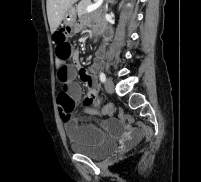 File:Closed loop small bowel obstruction (Radiopaedia 71211-81508 C 92).jpg