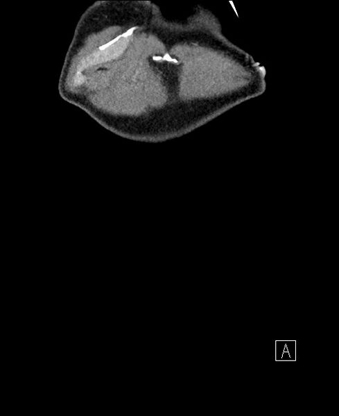 File:Closed loop small bowel obstruction - internal hernia (Radiopaedia 57806-64778 A 1).jpg