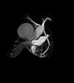 Distended gallbladder appearing as a snail (Rorschach radiology) (Radiopaedia 48812).jpg
